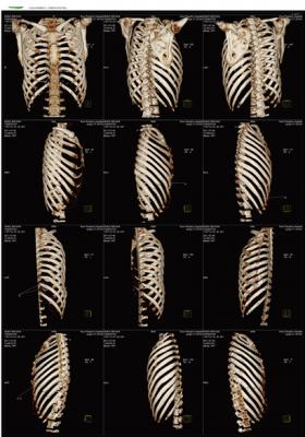 醫(yī)用ct膠片-肋骨