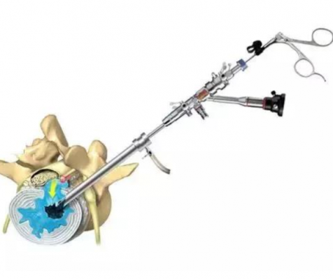 脊柱內(nèi)窺鏡spinal endoscope